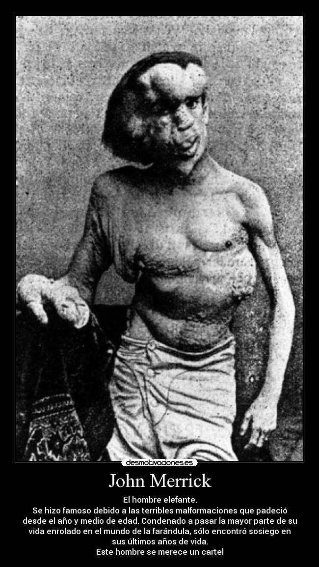 John Merrick - El hombre elefante.
Se hizo famoso debido a las terribles malformaciones que padeció
desde el año y medio de edad. Condenado a pasar la mayor parte de su
vida enrolado en el mundo de la farándula, sólo encontró sosiego en
sus últimos años de vida.
Este hombre se merece un cartel