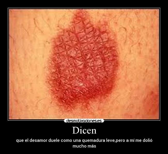 Dicen - que el desamor duele como una quemadura leve,pero a mí me dolió mucho más