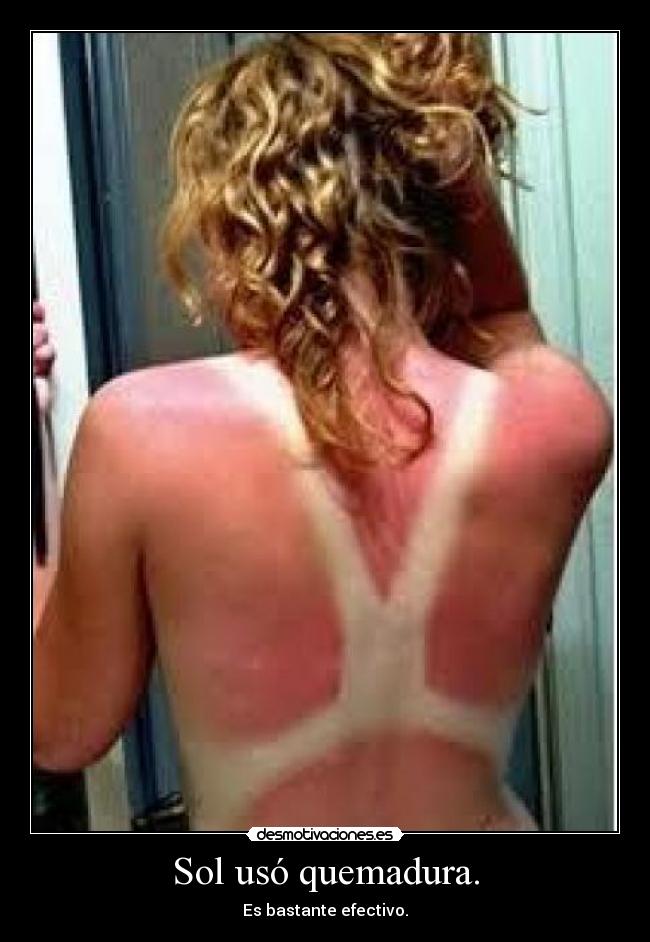 Sol usó quemadura. -