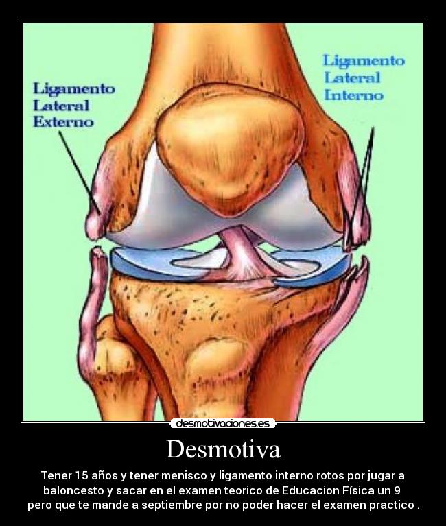 Desmotiva - Tener 15 años y tener menisco y ligamento interno rotos por jugar a
baloncesto y sacar en el examen teorico de Educacion Física un 9
pero que te mande a septiembre por no poder hacer el examen practico .