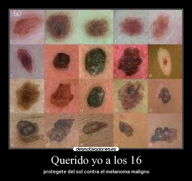 Querido yo a los 16 - protegete del sol contra el melanoma maligno