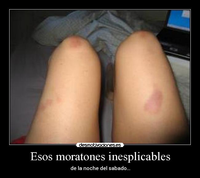 Esos moratones inesplicables -