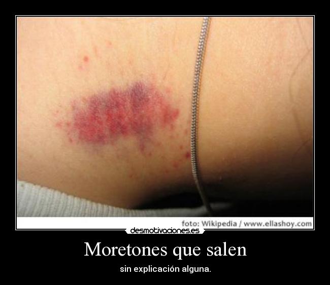 Moretones que salen - 