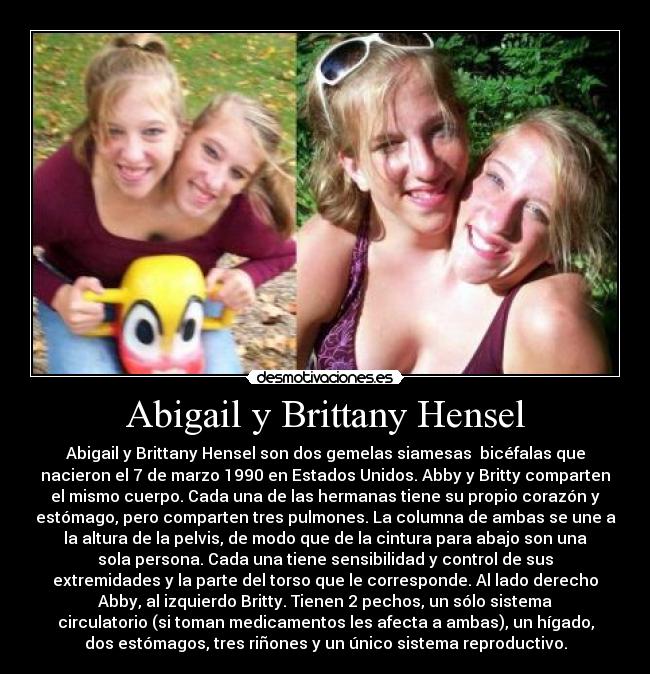 Abigail y Brittany Hensel - Abigail y Brittany Hensel son dos gemelas siamesas  bicéfalas que
nacieron el 7 de marzo 1990 en Estados Unidos. Abby y Britty comparten
el mismo cuerpo. Cada una de las hermanas tiene su propio corazón y
estómago, pero comparten tres pulmones. La columna de ambas se une a
la altura de la pelvis, de modo que de la cintura para abajo son una
sola persona. Cada una tiene sensibilidad y control de sus
extremidades y la parte del torso que le corresponde. Al lado derecho
Abby, al izquierdo Britty. Tienen 2 pechos, un sólo sistema
circulatorio (si toman medicamentos les afecta a ambas), un hígado,
dos estómagos, tres riñones y un único sistema reproductivo.