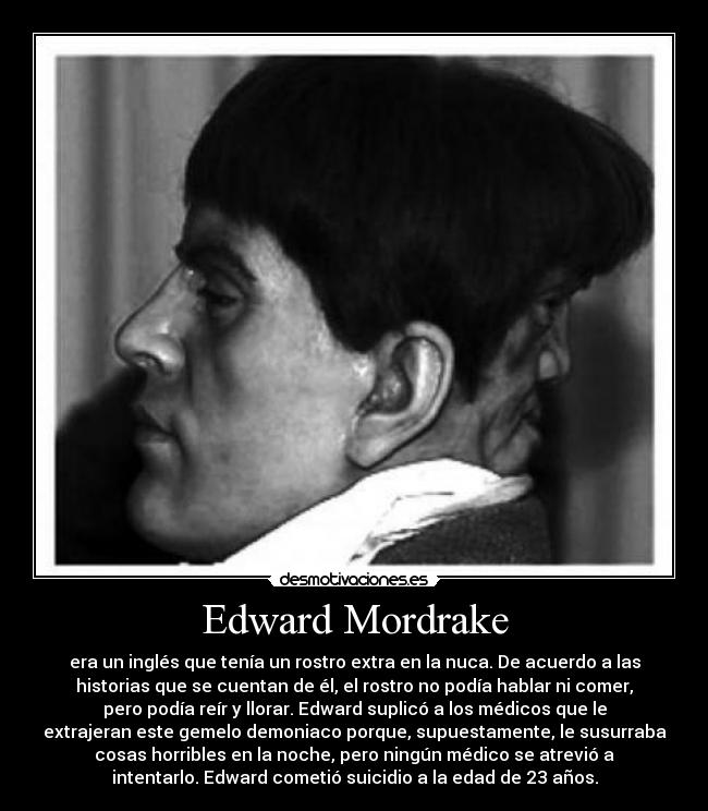 Edward Mordrake - era un inglés que tenía un rostro extra en la nuca. De acuerdo a las
historias que se cuentan de él, el rostro no podía hablar ni comer,
pero podía reír y llorar. Edward suplicó a los médicos que le
extrajeran este gemelo demoniaco porque, supuestamente, le susurraba
cosas horribles en la noche, pero ningún médico se atrevió a
intentarlo. Edward cometió suicidio a la edad de 23 años.