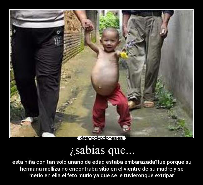 ¿sabias que... - esta niña con tan solo unaño de edad estaba embarazada?fue porque su
hermana melliza no encontraba sitio en el vientre de su madre y se
metio en ella.el feto murio ya que se le tuvieronque extripar