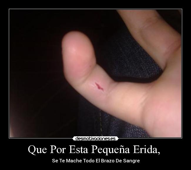 Que Por Esta Pequeña Erida, - Se Te Mache Todo El Brazo De Sangre