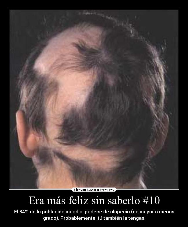 Era más feliz sin saberlo #10 - El 84% de la población mundial padece de alopecia (en mayor o menos
grado). Probablemente, tú también la tengas.