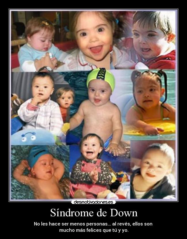 Síndrome de Down -