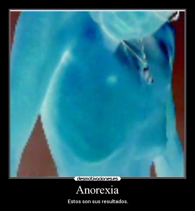 Anorexia -