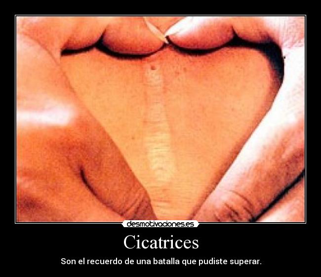 Cicatrices - Son el recuerdo de una batalla que pudiste superar.