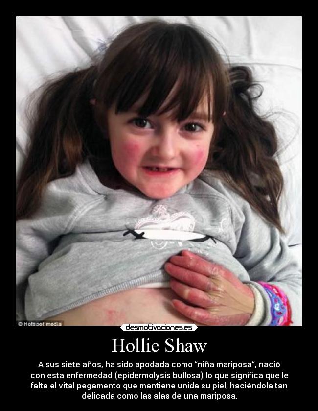 Hollie Shaw - A sus siete años, ha sido apodada como “niña mariposa“, nació
con esta enfermedad (epidermolysis bullosa) lo que significa que le
falta el vital pegamento que mantiene unida su piel, haciéndola tan
delicada como las alas de una mariposa.