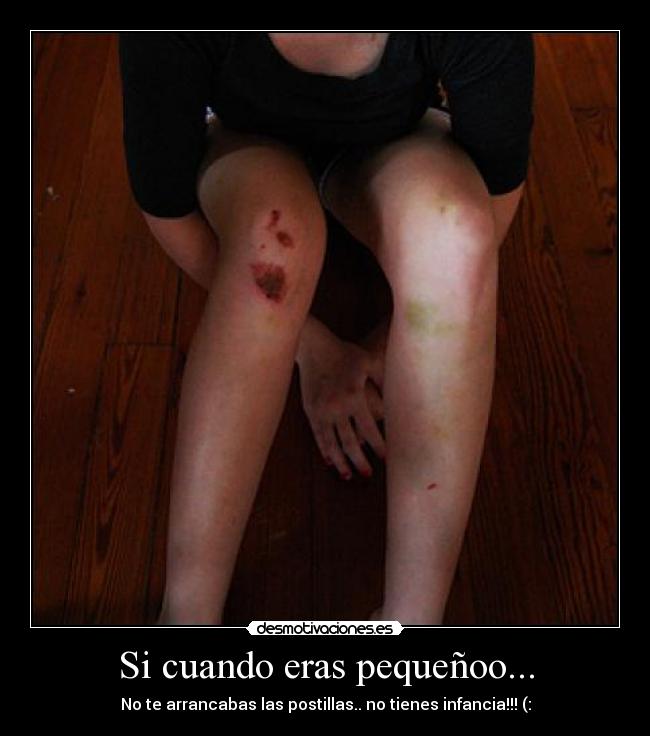 Si cuando eras pequeñoo... - No te arrancabas las postillas.. no tienes infancia!!! (: