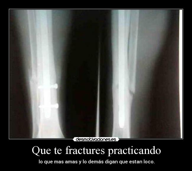 Que te fractures practicando -