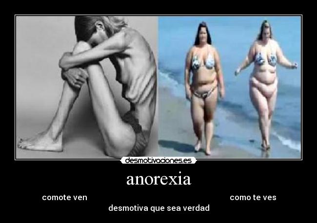 anorexia -