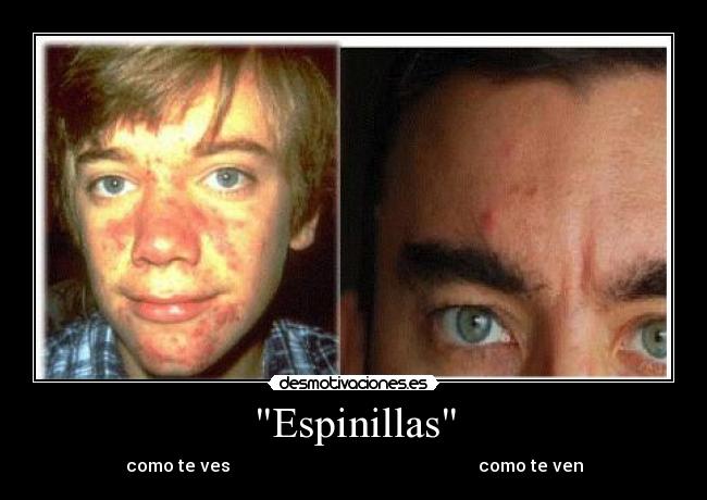 Espinillas - 