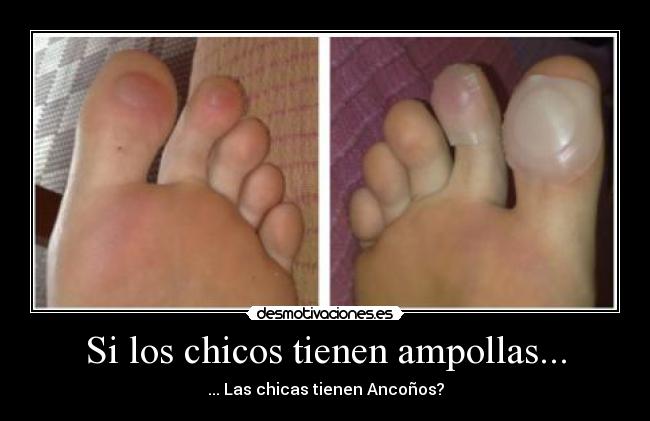 Si los chicos tienen ampollas... - 