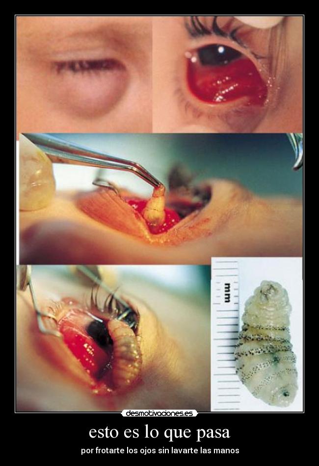 esto es lo que pasa - por frotarte los ojos sin lavarte las manos