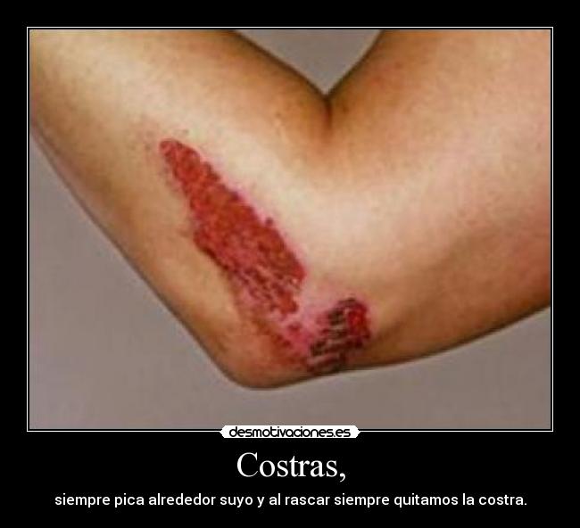 Costras, - 