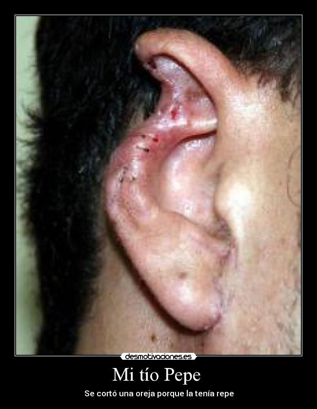 Mi tío Pepe  - Se cortó una oreja porque la tenía repe