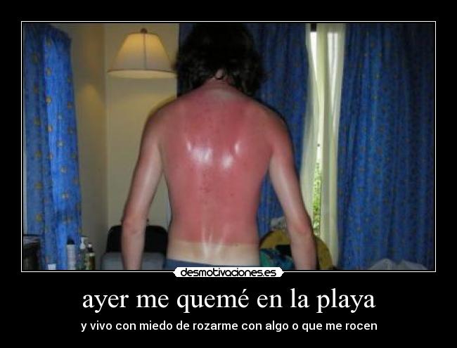 ayer me quemé en la playa - y vivo con miedo de rozarme con algo o que me rocen