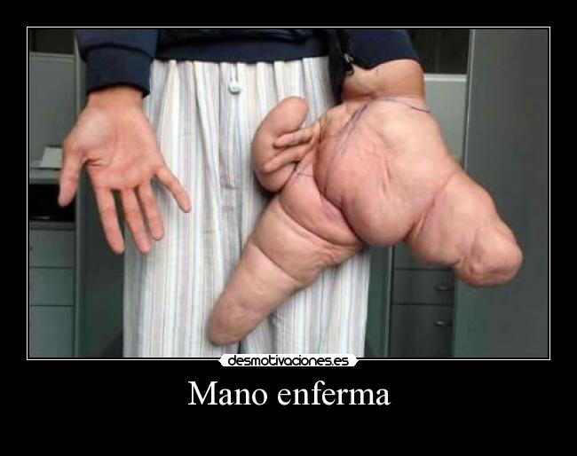 Mano enferma -