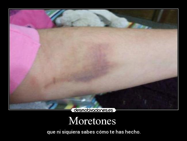 Moretones -
