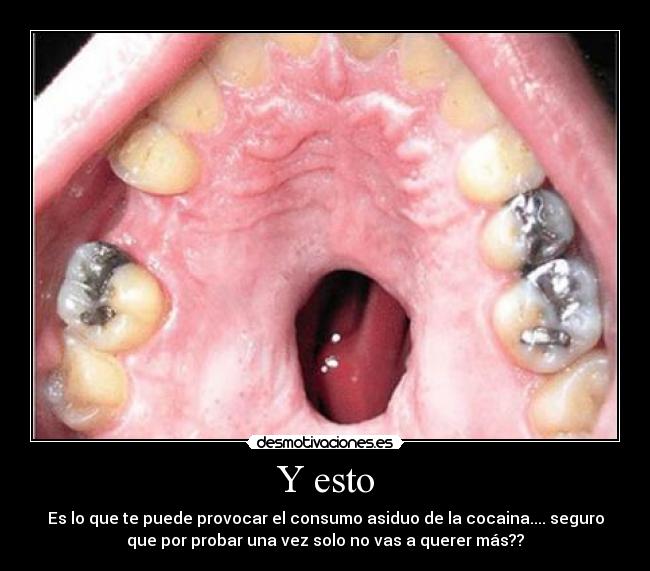 Y esto - Es lo que te puede provocar el consumo asiduo de la cocaina.... seguro
que por probar una vez solo no vas a querer más??