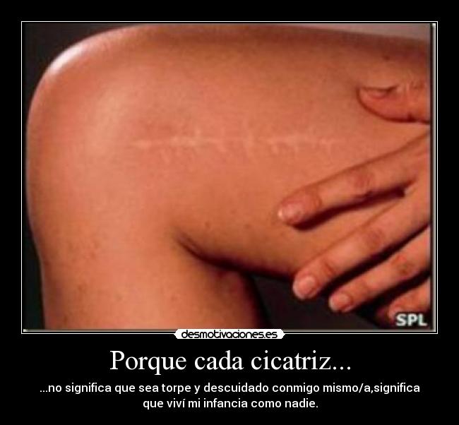 Porque cada cicatriz... - ...no significa que sea torpe y descuidado conmigo mismo/a,significa
que viví mi infancia como nadie.