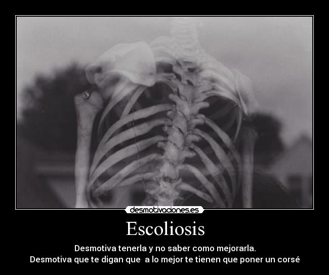 Escoliosis - Desmotiva tenerla y no saber como mejorarla.
Desmotiva que te digan que  a lo mejor te tienen que poner un corsé
