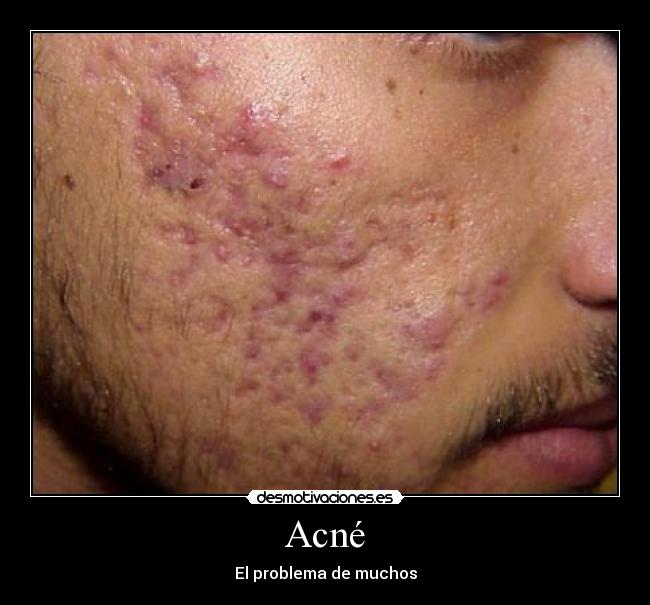 Acné - El problema de muchos