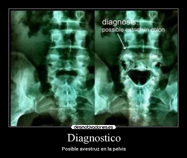 Diagnostico - Posible avestruz en la pelvis