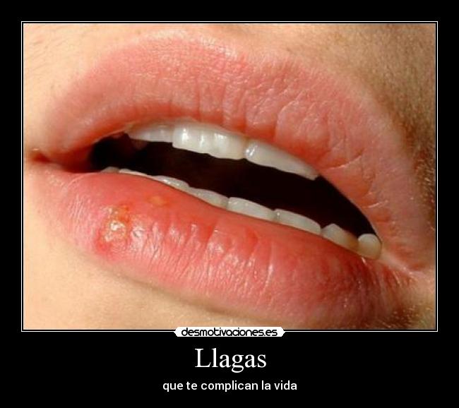 Llagas - que te complican la vida