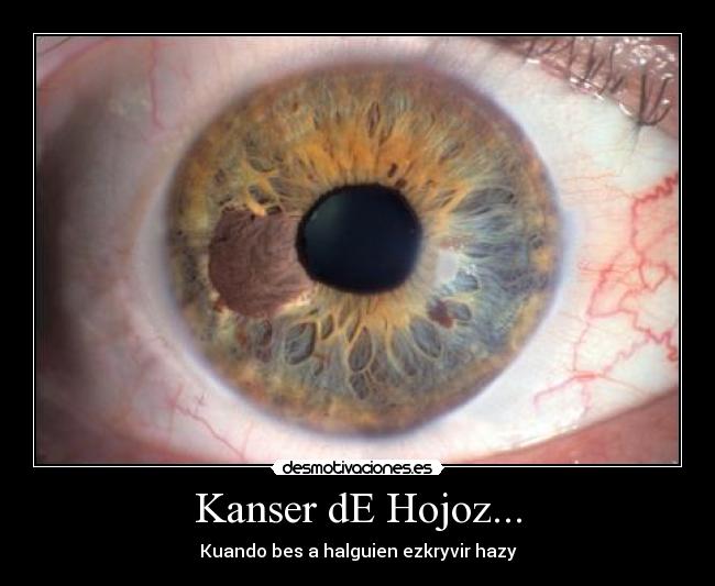 Kanser dE Hojoz... - 