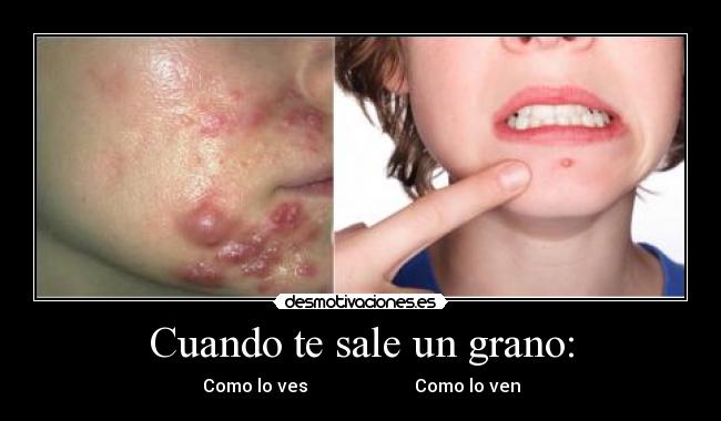 Cuando te sale un grano: - Como lo ves Como lo ven