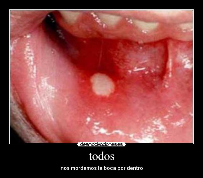 todos - nos mordemos la boca por dentro