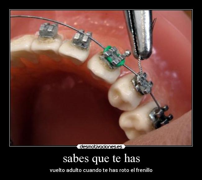 sabes que te has - vuelto adulto cuando te has roto el frenillo