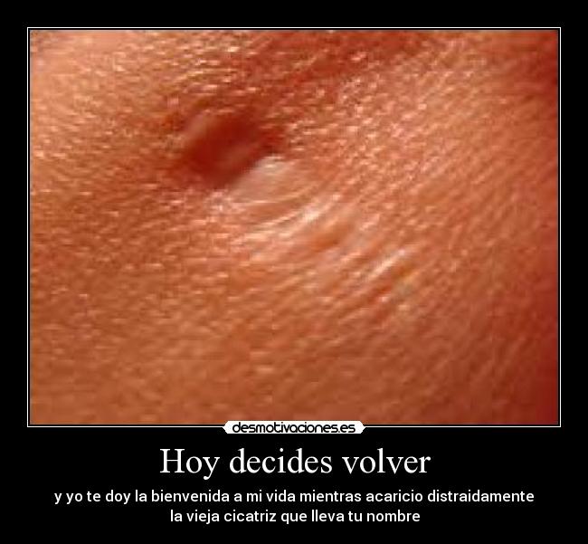 Hoy decides volver - y yo te doy la bienvenida a mi vida mientras acaricio distraidamente
la vieja cicatriz que lleva tu nombre