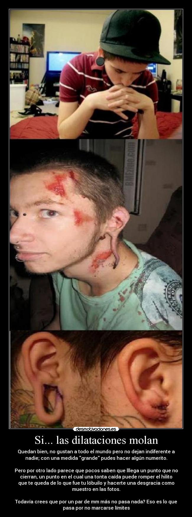 Si... las dilataciones molan - Quedan bien, no gustan a todo el mundo pero no dejan indiferente a
nadie; con una medida grande pudes hacer algún numerito.

Pero por otro lado parece que pocos saben que lllega un punto que no
cierran, un punto en el cual una tonta caída puede romper el hilito
que te queda de lo que fue tu lóbuilo y hacerte una desgracia como
muestro en las fotos.

Todavía crees que por un par de mm más no pasa nada? Eso es lo que
pasa por no marcarse límites