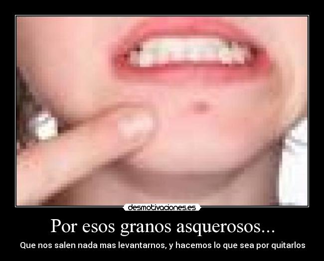 Por esos granos asquerosos... - 