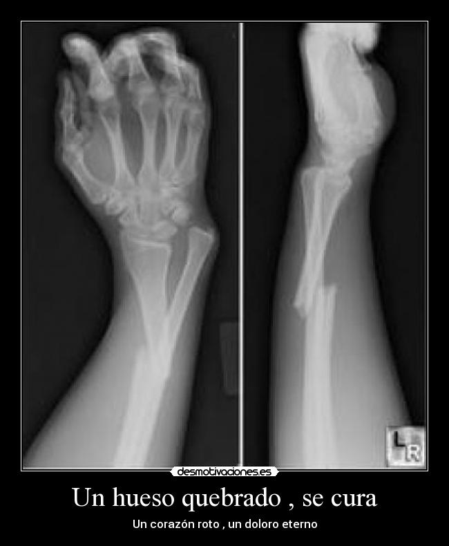 Un hueso quebrado , se cura - Un corazón roto , un doloro eterno