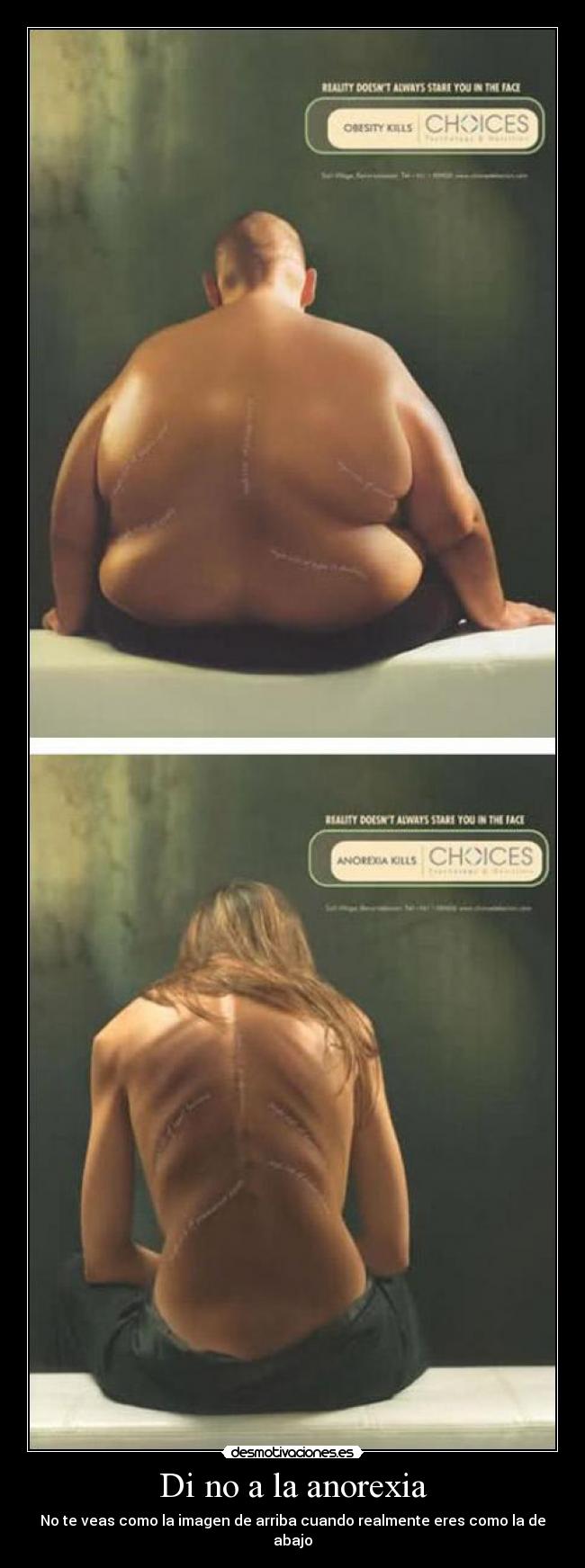 Di no a la anorexia - No te veas como la imagen de arriba cuando realmente eres como la de abajo