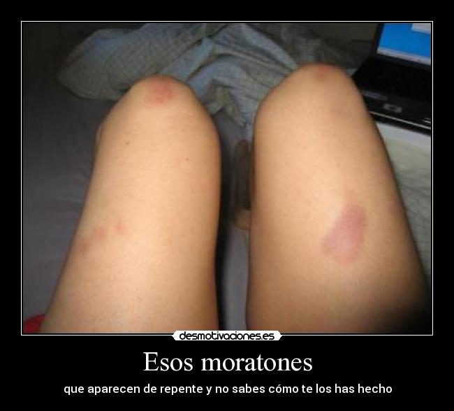 Esos moratones -