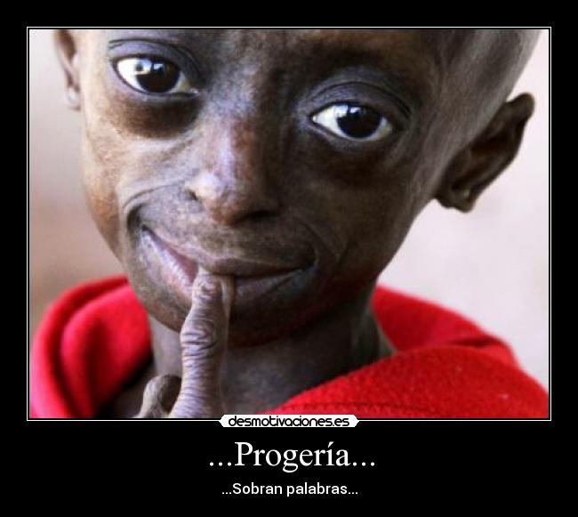 ...Progería... - ...Sobran palabras...