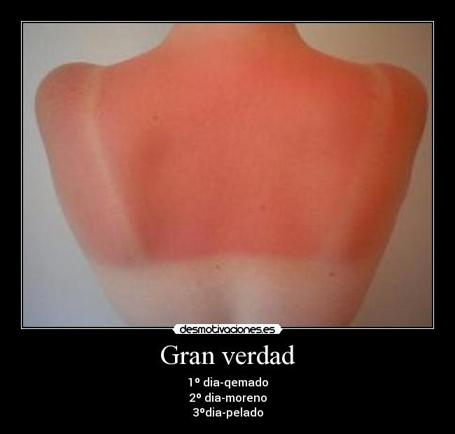 Gran verdad - 1º dia-qemado
2º dia-moreno
3ºdia-pelado