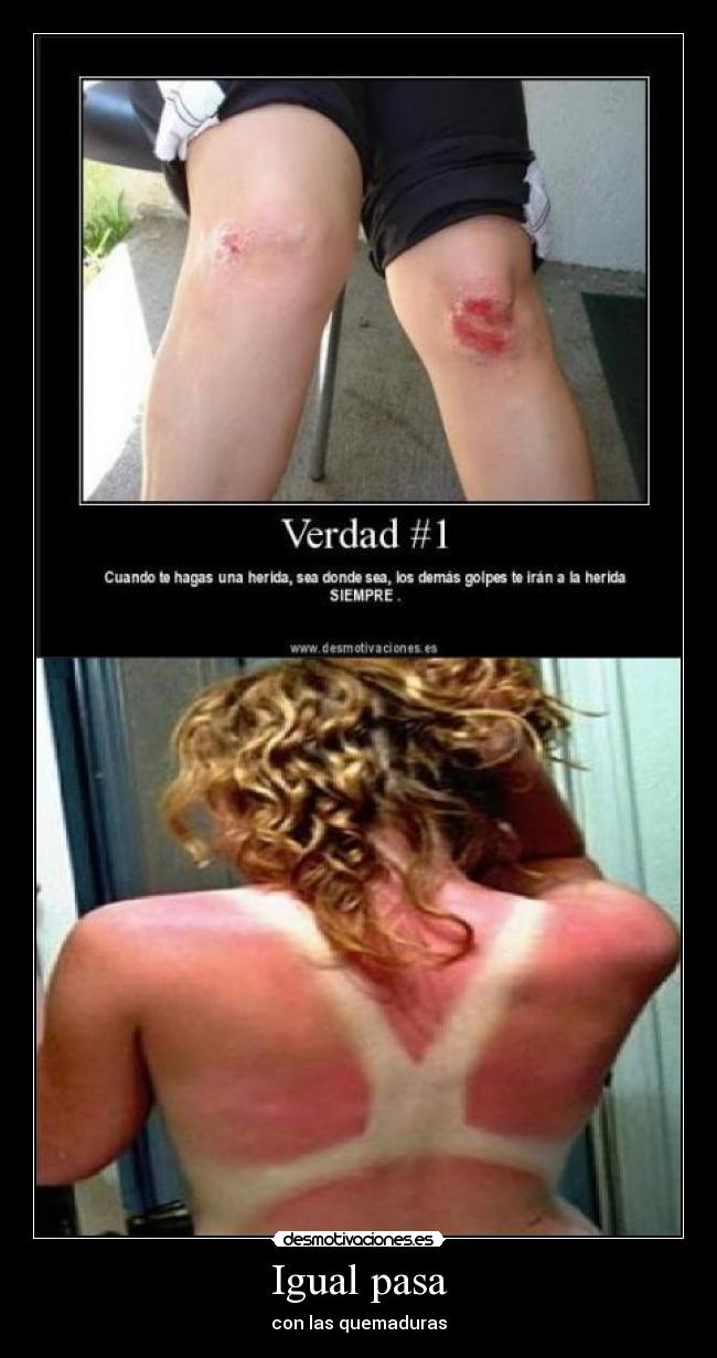 Igual pasa - con las quemaduras