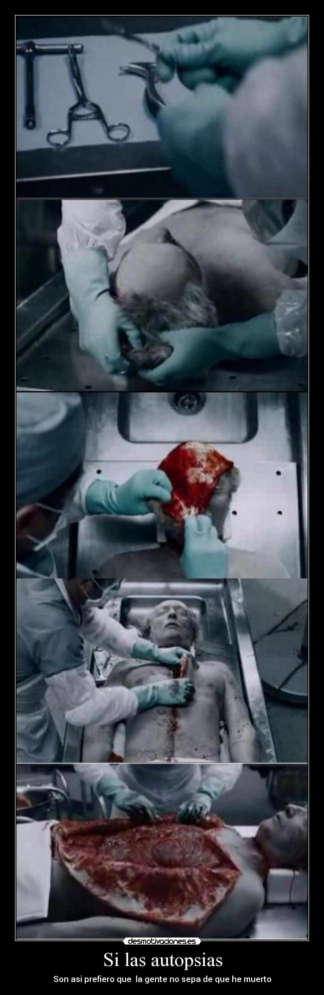 Si las autopsias - Son asi prefiero que  la gente no sepa de que he muerto
