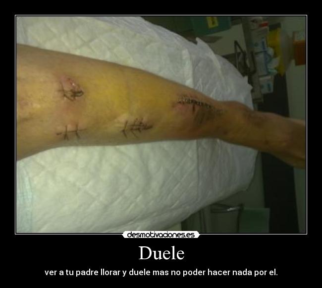 Duele -