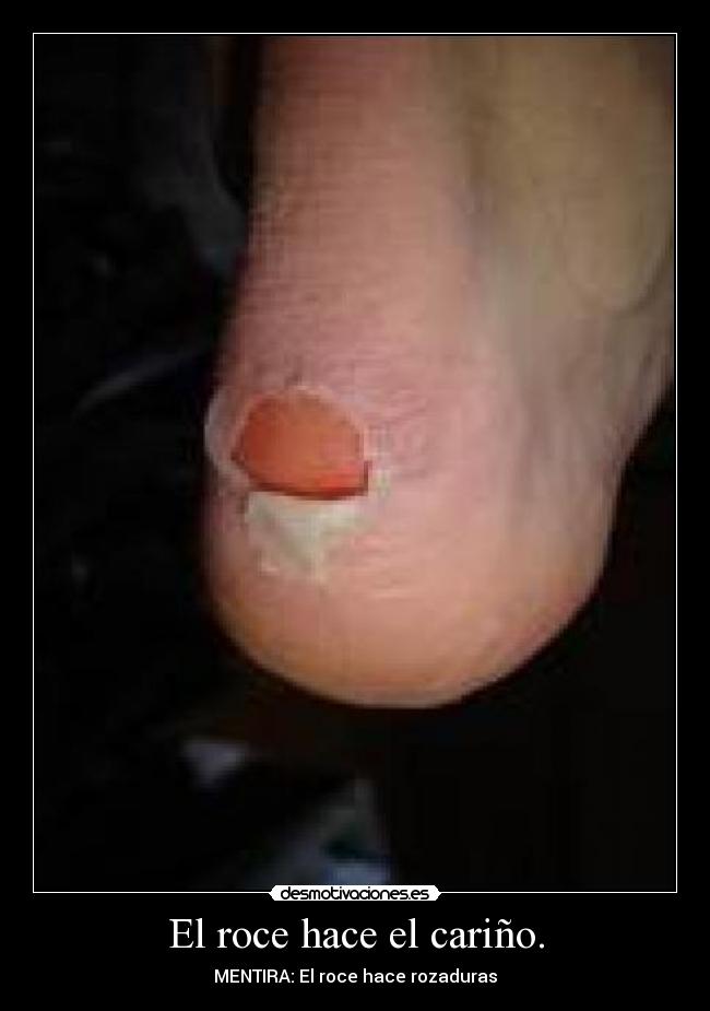 El roce hace el cariño. - MENTIRA: El roce hace rozaduras