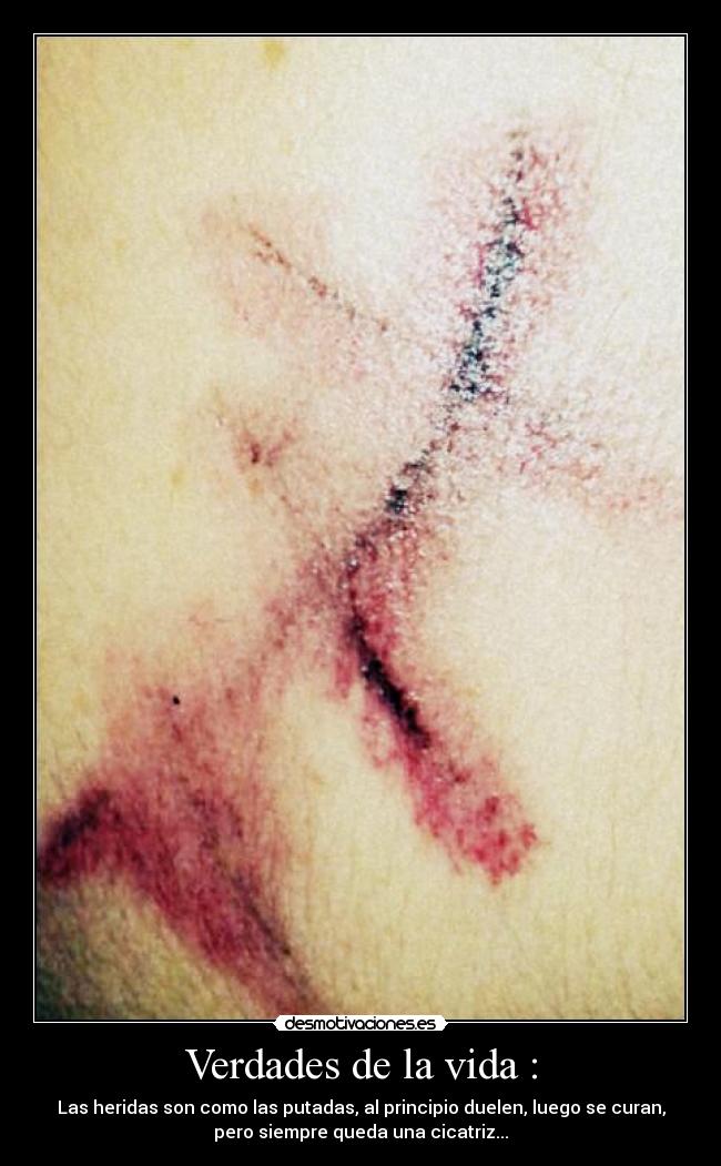 Verdades de la vida : - Las heridas son como las putadas, al principio duelen, luego se curan,
pero siempre queda una cicatriz...